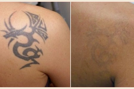usuwanie tatuażów